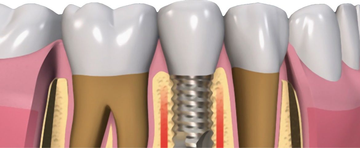 el implante dental, componentes fexdental-adimentos-dentales