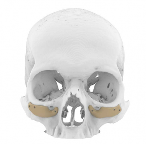 Cirugía Maxilofacial, Laboratorio digital 3D para planificar osteotomías faciales