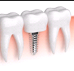 FexDental. Aditamentos dentales compatibles, FexDental. Aditamentos Dentales Compatibles.