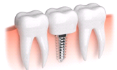 El implante dental, IMPLANTES DENTALES