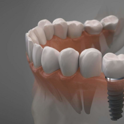 tipos de implantes dentales, Distintos tipos de implantes dentales y en qué casos se utiliza cada uno