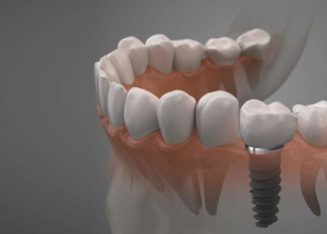 tipos de implantes dentales, Distintos tipos de implantes dentales y en qué casos se utiliza cada uno