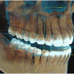 implante dental gana precisión, El implante dental gana precisión